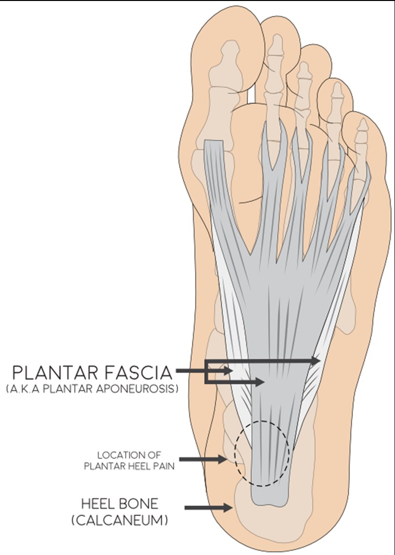 Plantar Fascia NHS Lanarkshire