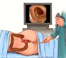 a colonoscopy