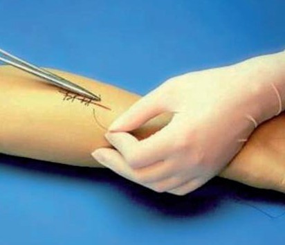 stitches in an arm