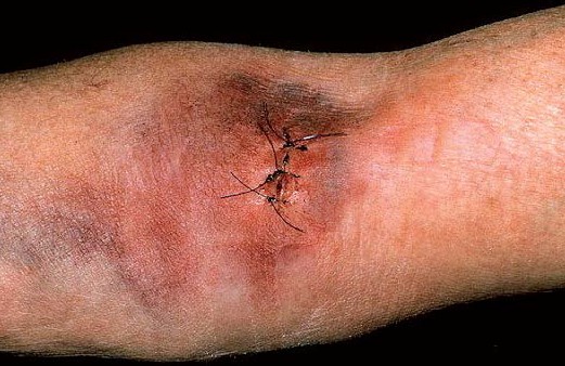 stiches in an arm