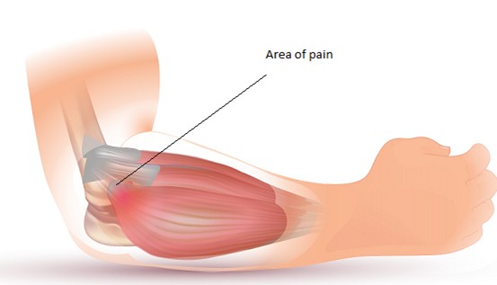 diagram of an arm with a arrow pointing to a tendon at the outside of the elbow