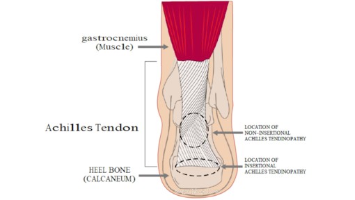 Achilles Tendinopathy