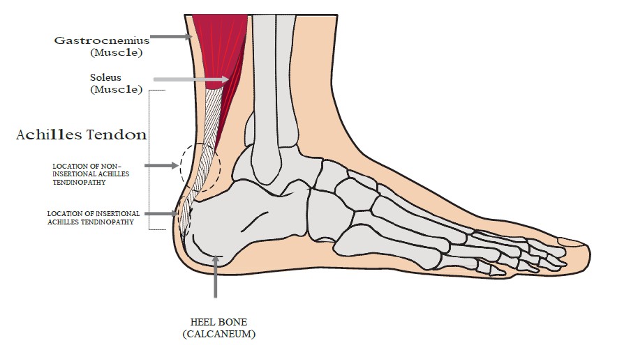 How to manage achilles tendinopathy