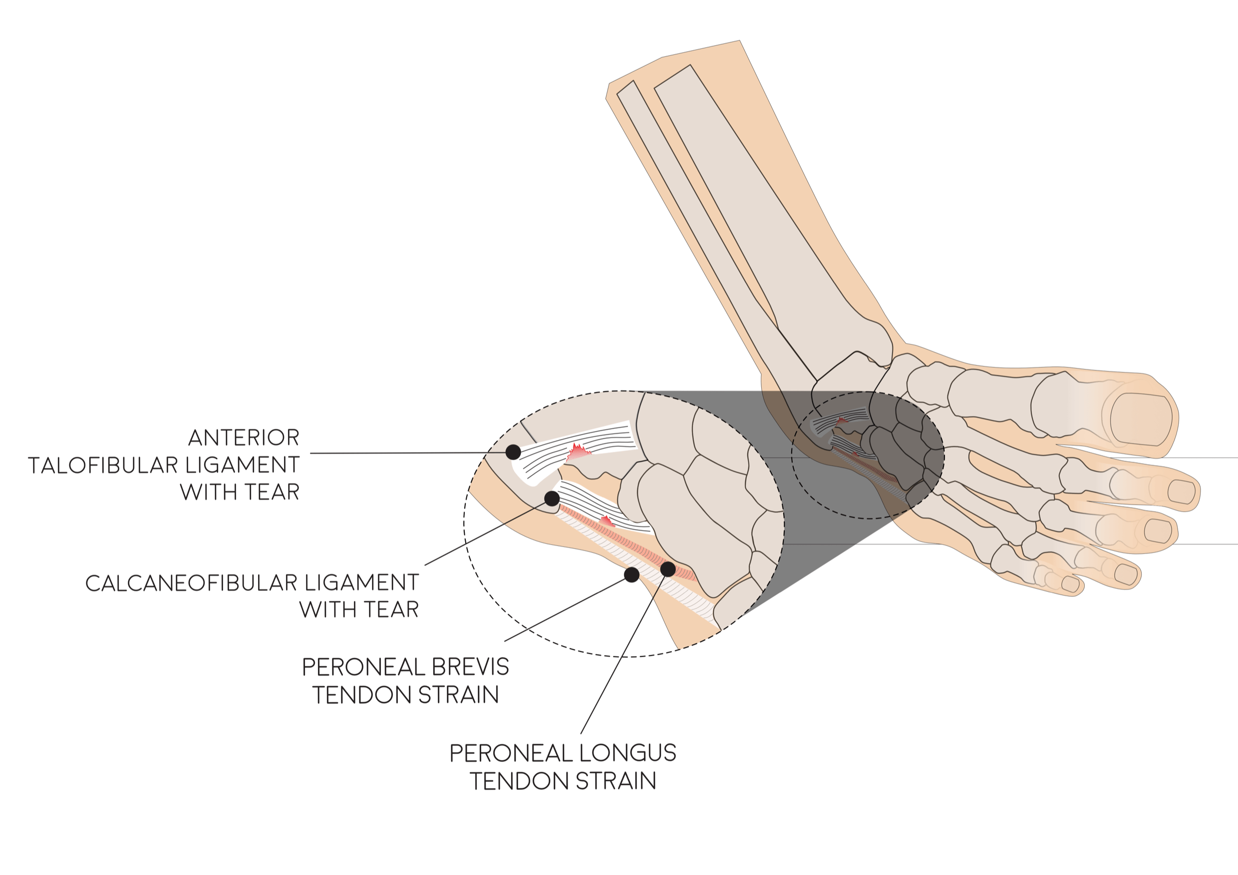 Ankle Tear