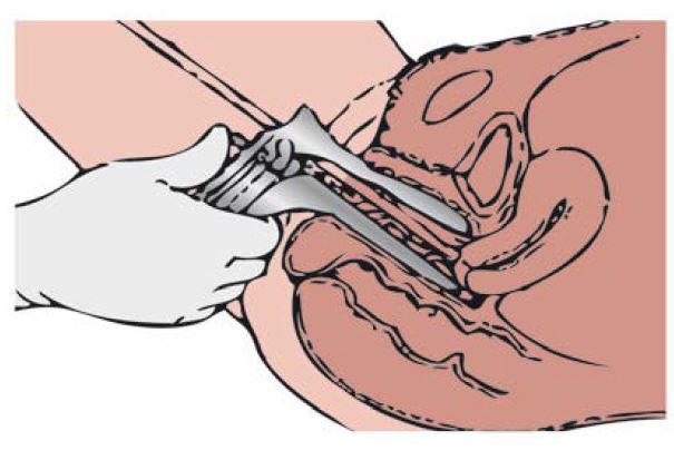 speculum