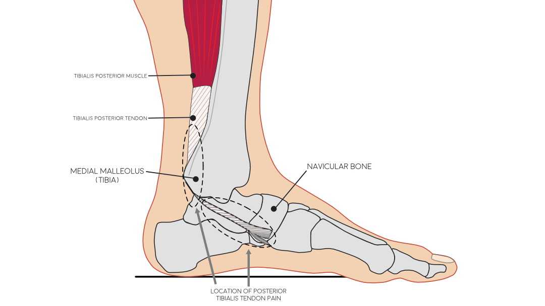 Haglund's deformity: Treatment, exercises, pictures, and causes