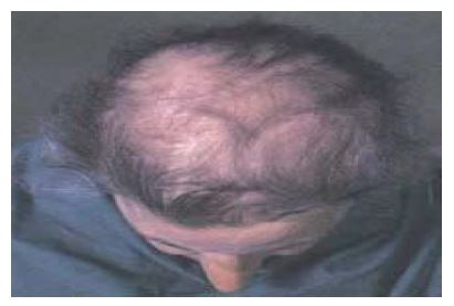 a person losing their hair