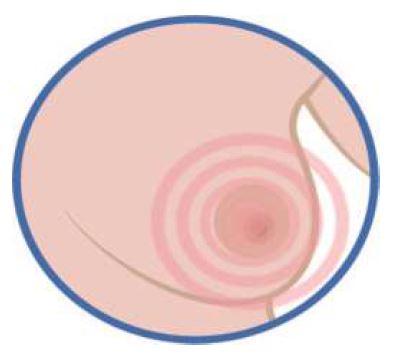 breast with red rings showing an area of pain
