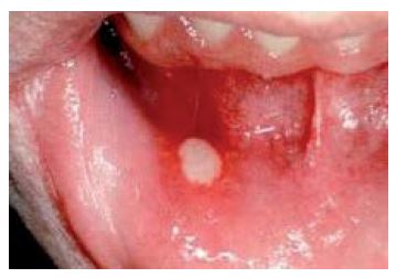 mouth ulcers