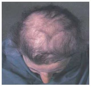 the top of a persons head with visible hair loss