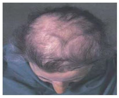 hair loss