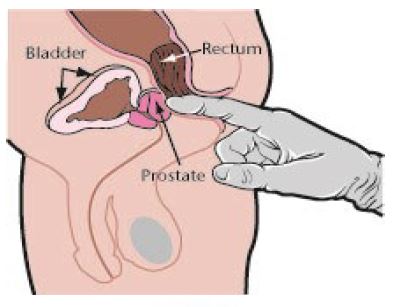 prostate exam