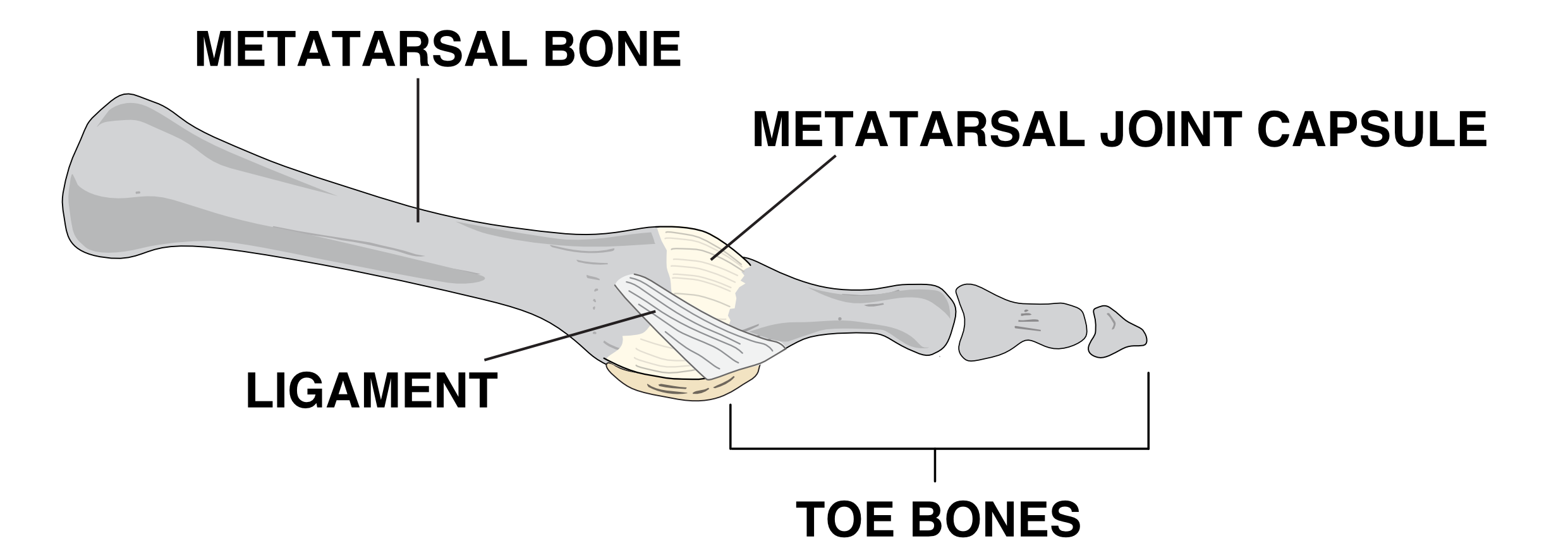 Illustration of the metatarsal and the toe and this shows the location of the joint capsule