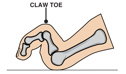 Illustration of a claw toe
