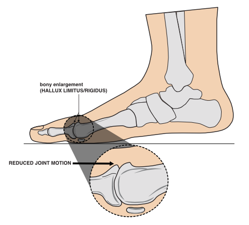 side of the foot displaying bone enlargement which reduces joint motion