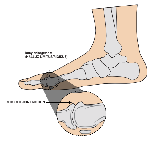 Hallux rigidus