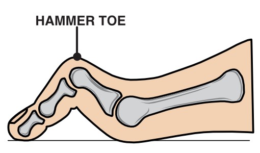 Illustration of a hammer toe