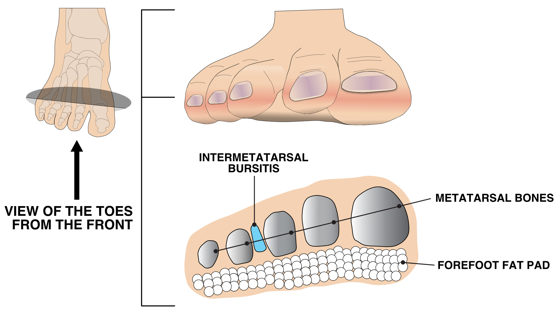 Illustration of forefoot displaying the intermetatarsal burisitis in between the metatarsals