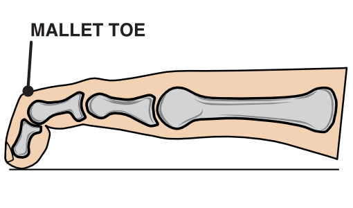 Illustration of a mallet toe