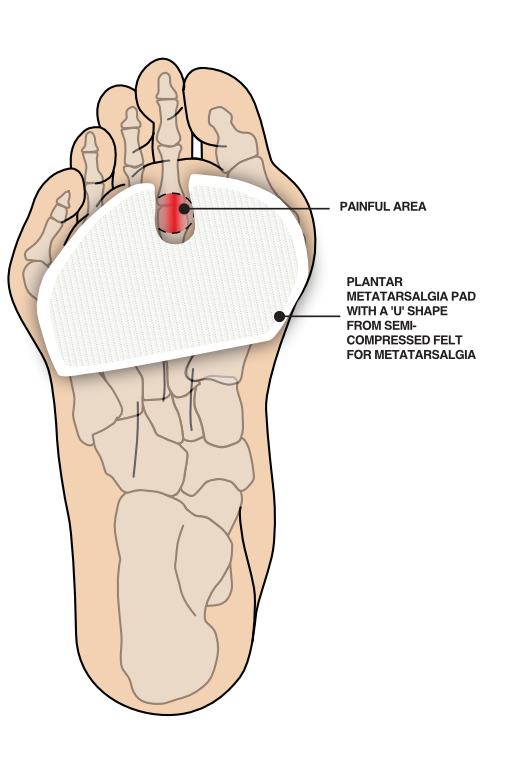 Illustration example of padding for metatarsalgia