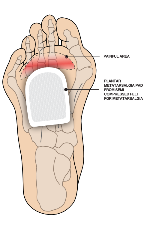 Illustration example of padding for metatarsalgia