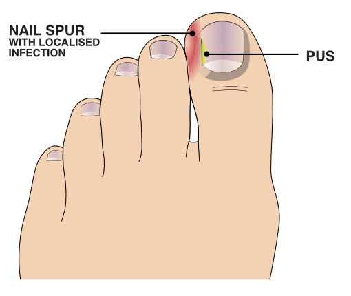 Illustration of nail with pus and showing an ingrown toenail