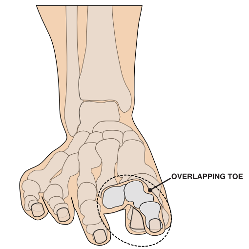 illustration of an overlapping 2nd toe