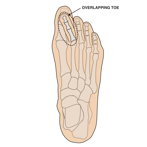 Illustration of an overlapping toe from a view from above.