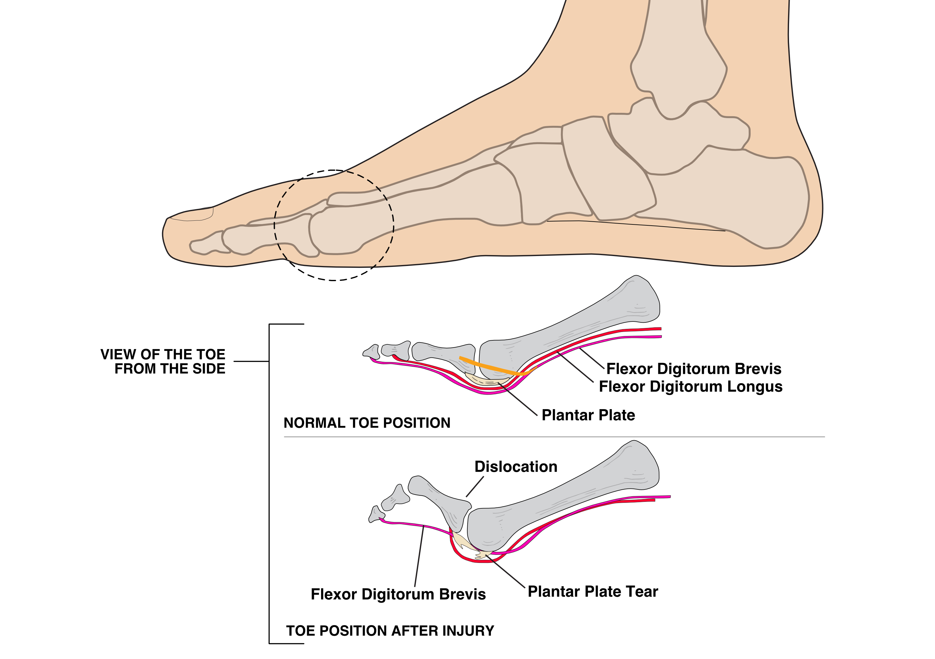Illustration of the side of the toe showing the changing tissue following a plantar plate injury