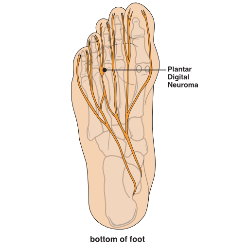 Illustration of plantar foot showing location of plantar digital neuroma