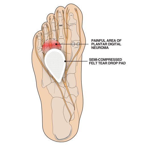 Illustration of padding to help with a plantar digital neuroma