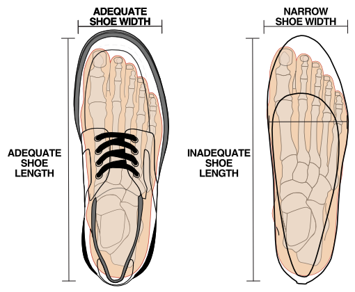 Illustration of tight shoes