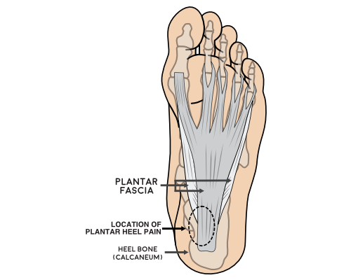 View of the bottom of the foot showing plantar heel location
