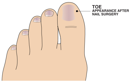 Illustration of toe after nail surgery