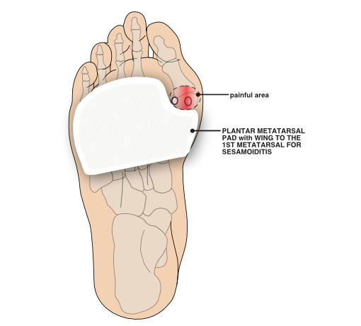 Plantar view of foot with padding applied for sesamoiditis