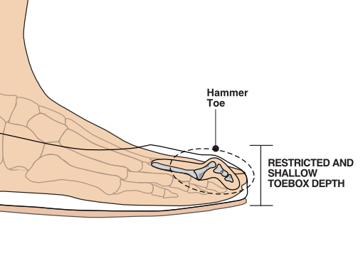 Illustration of poor shoe toebox depth