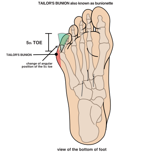 Illustration of a tailor's bunion view of the bottom of the foot