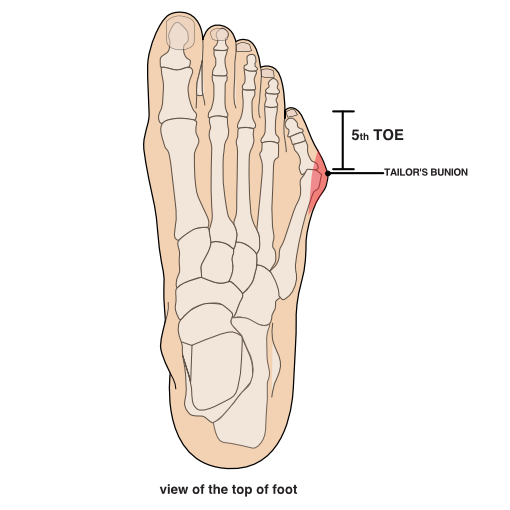 Illustration of a tailor's bunion view of the top of the foot