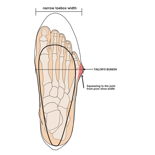 Illustration of tight fitting and narrow shoe of a tailor's bunion