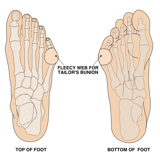 Illustration of padding example for tailor's bunion