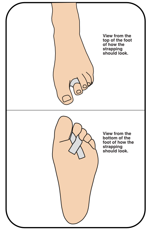 Illustration of how to use tape to strap a toe