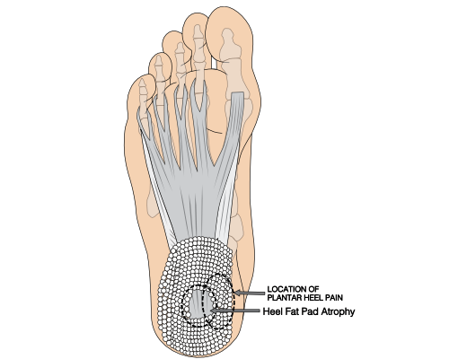 image of plantar foot with location of fat pad syndrome