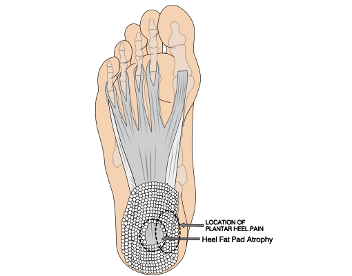 Got Heel Pain While Walking? Here's How to Relieve It