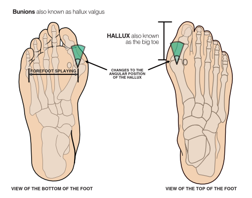 view of the top and bottom of a foot with hallux valgus (bunions)