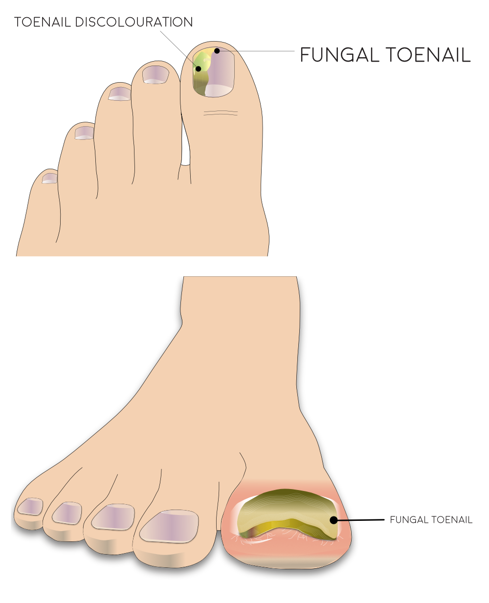 An illustration of the foot from above with fungal toe at the big toe and another illustration of the foot from the front of a fungal toenail