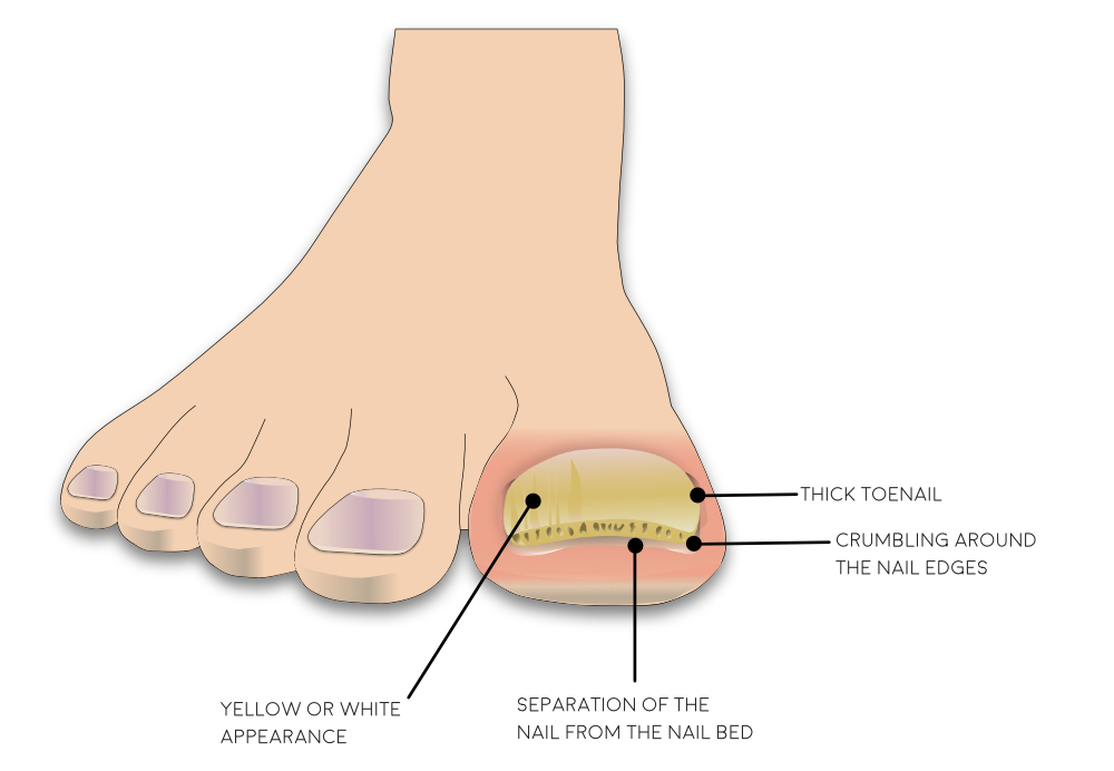 This is an illustration showing a foot with a thickened toenail