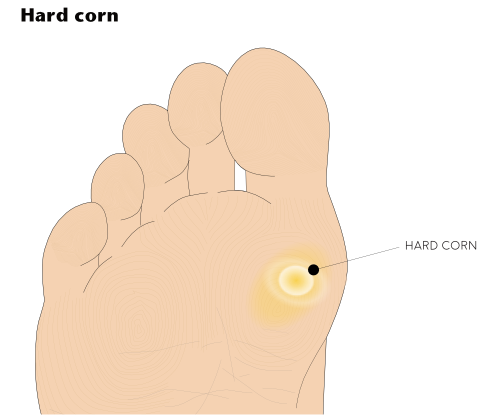Illustration of the plantar foot showing a corn to the 1st metatarsal head