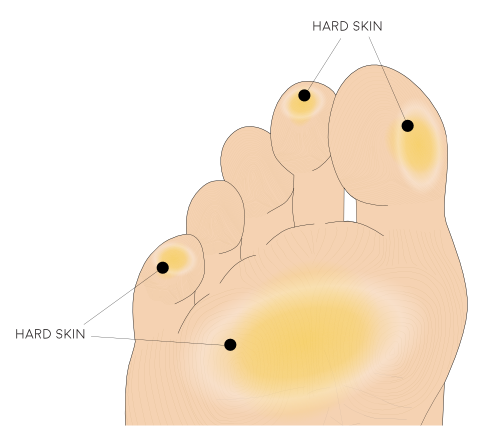 Illustration of the plantar foot displaying patches of hard skin