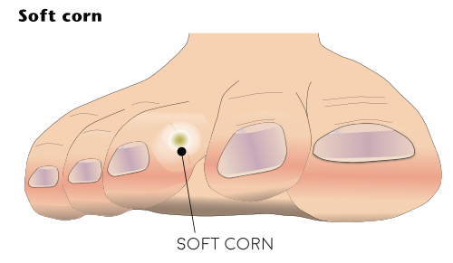 Illustration of the foot showing in between the toes a soft corn