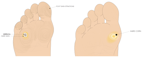 Illustration of the plantar of the foot at the toes displaying what a verruca appears like